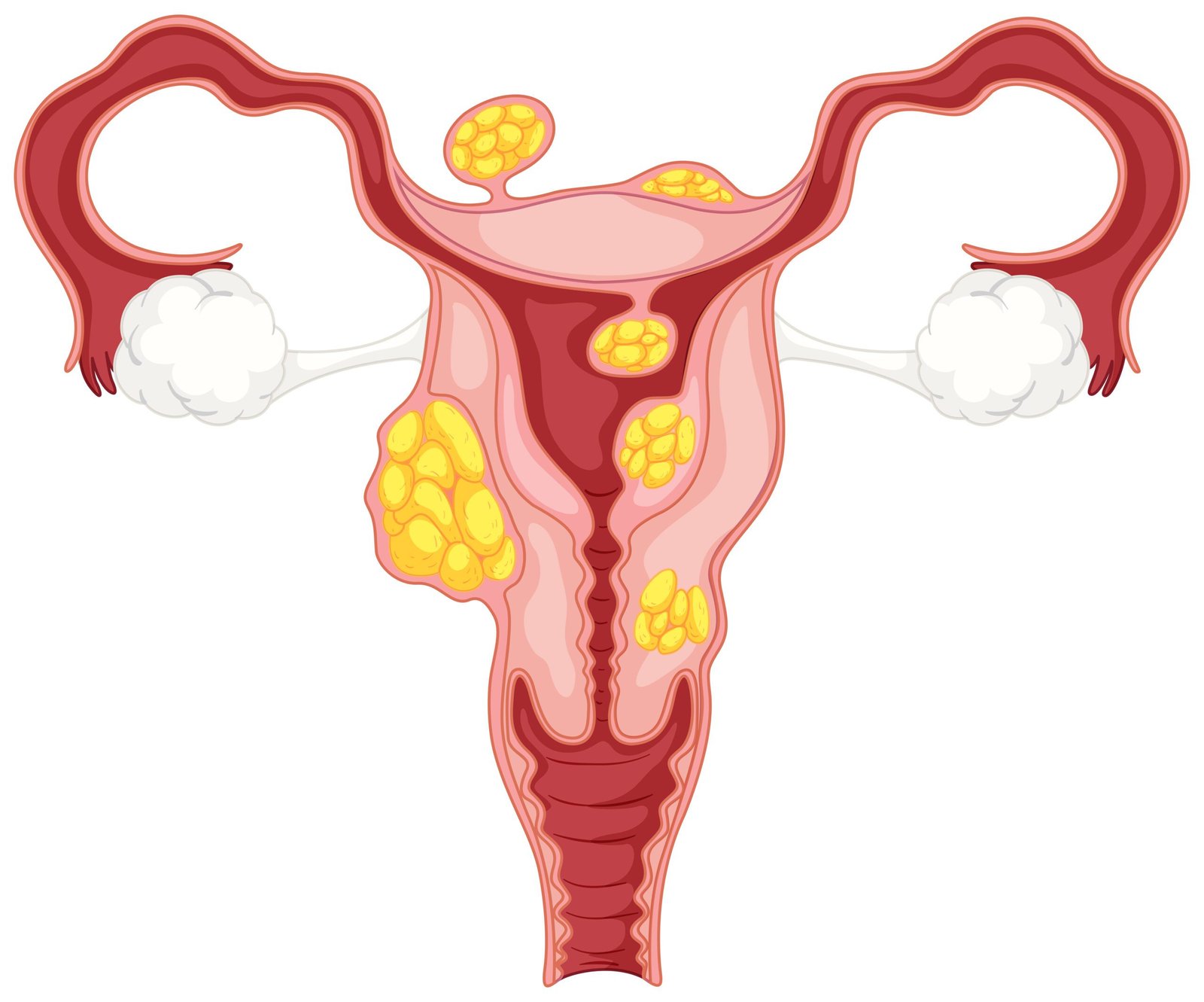 Uterine Fibroids: Causes, Symptoms And Treatments 124 Uterine Fibroids