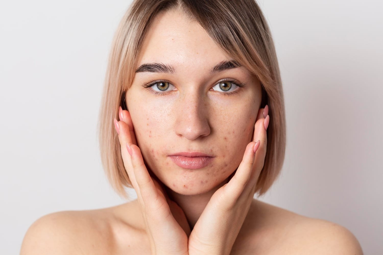 Top 10 Remedies for Acne-Prone Skin