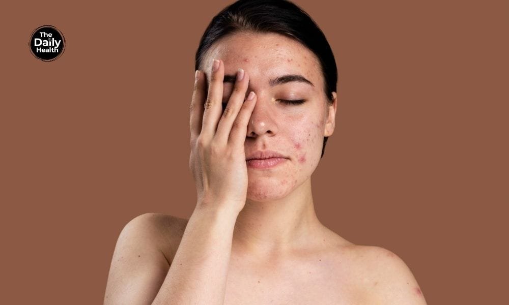 Top 10 Remedies for Acne-Prone Skin