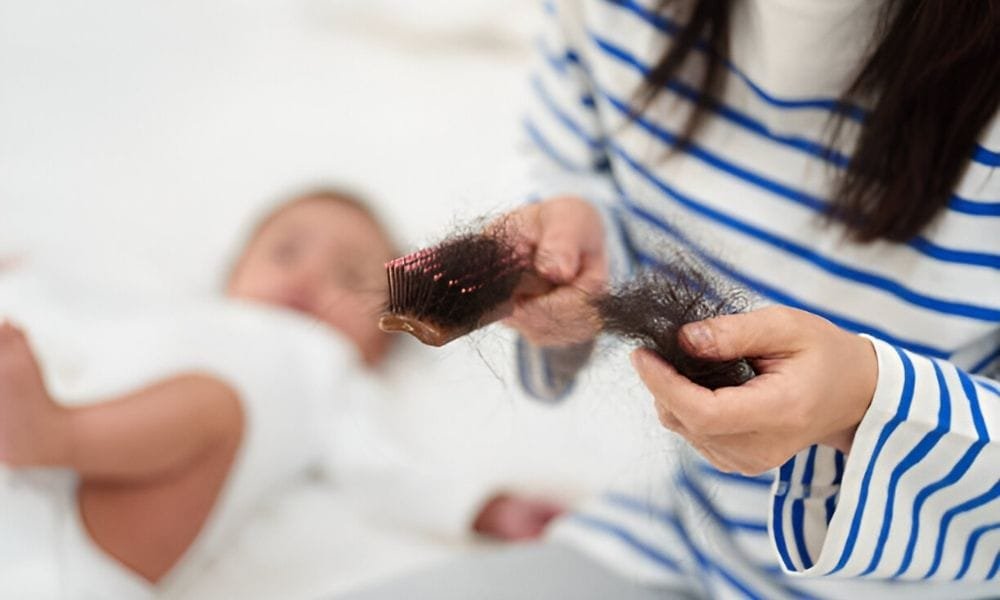 What is Postpartum Hair Loss? Causes and How to Manage It Naturally 23 What is Postpartum Hair Loss
